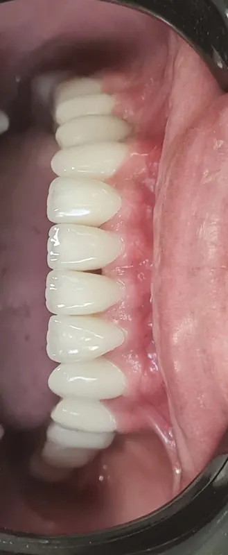 A full arch of new upper teeth, seen from below