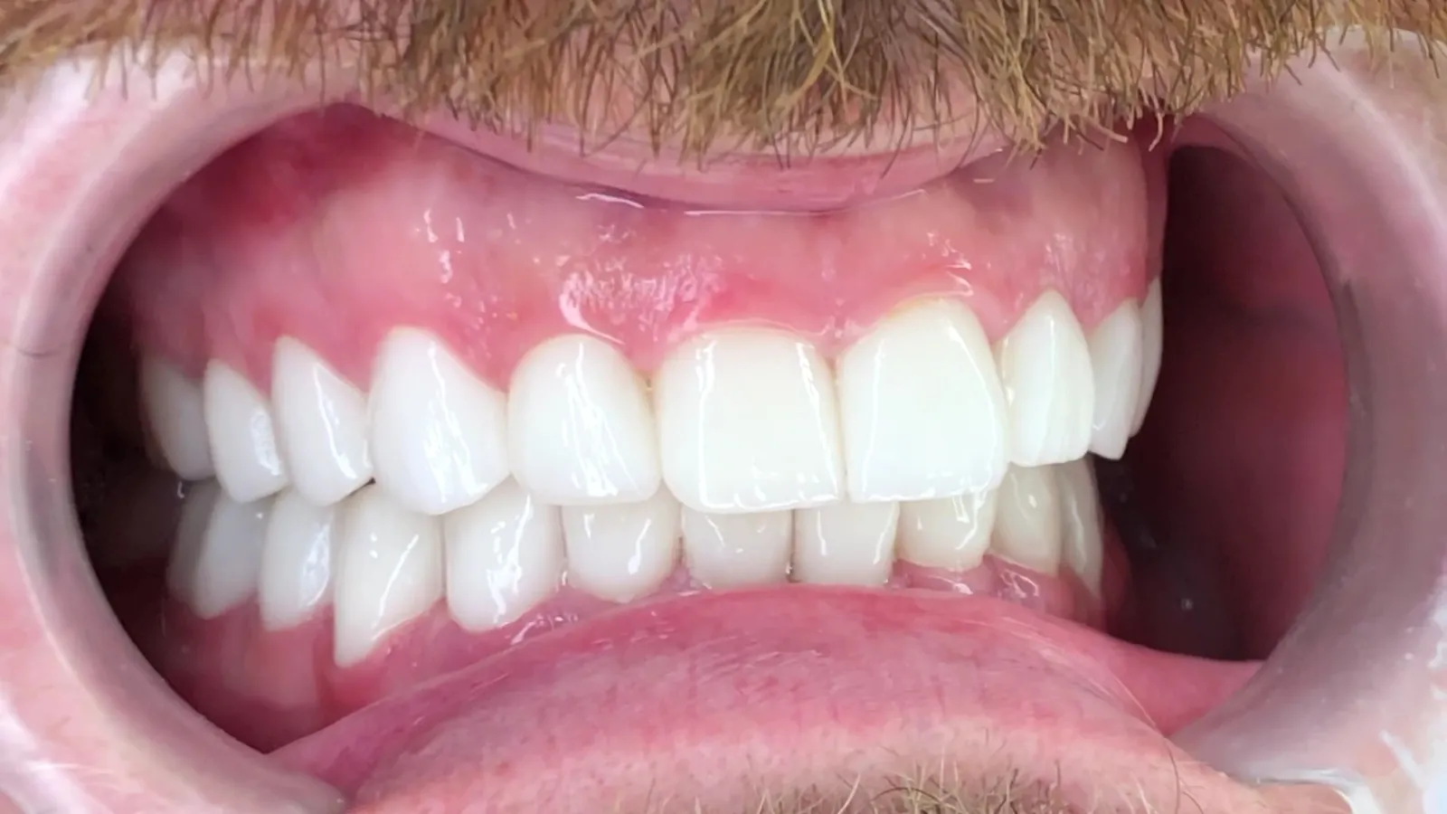 Close-up of restored, even front teeth