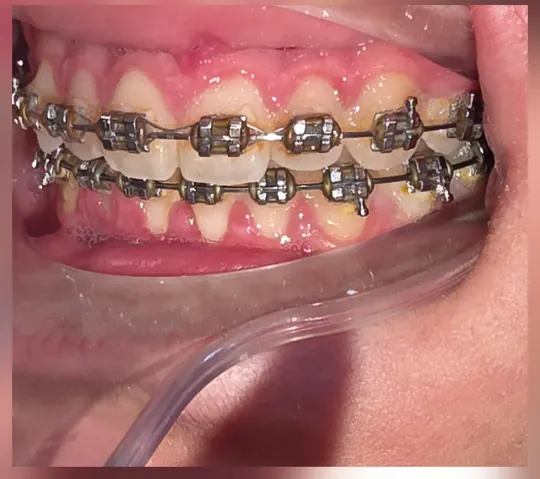 Fixed braces on a patient's teeth