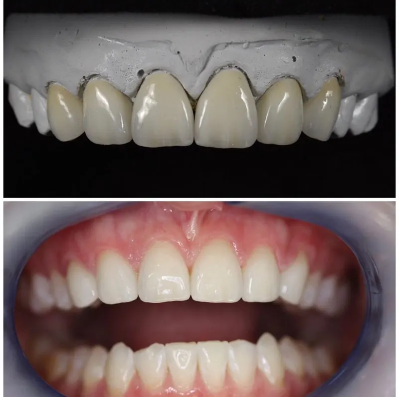Ceramic crowns on the model, and the same crowns in the mouth