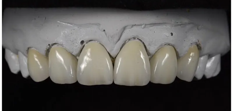 Ceramic crowns fitted on a plaster model