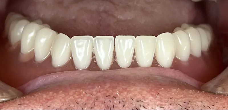 A restored lower arch of teeth