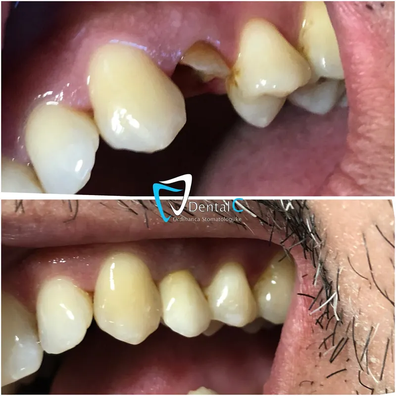 A broken front tooth before and after it was rebuilt