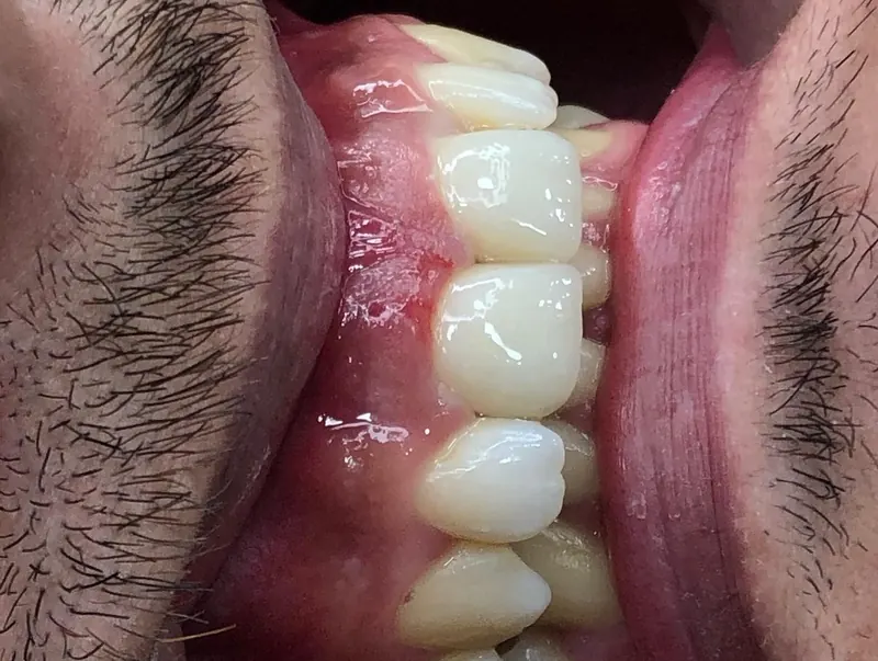 Side view of restored front teeth