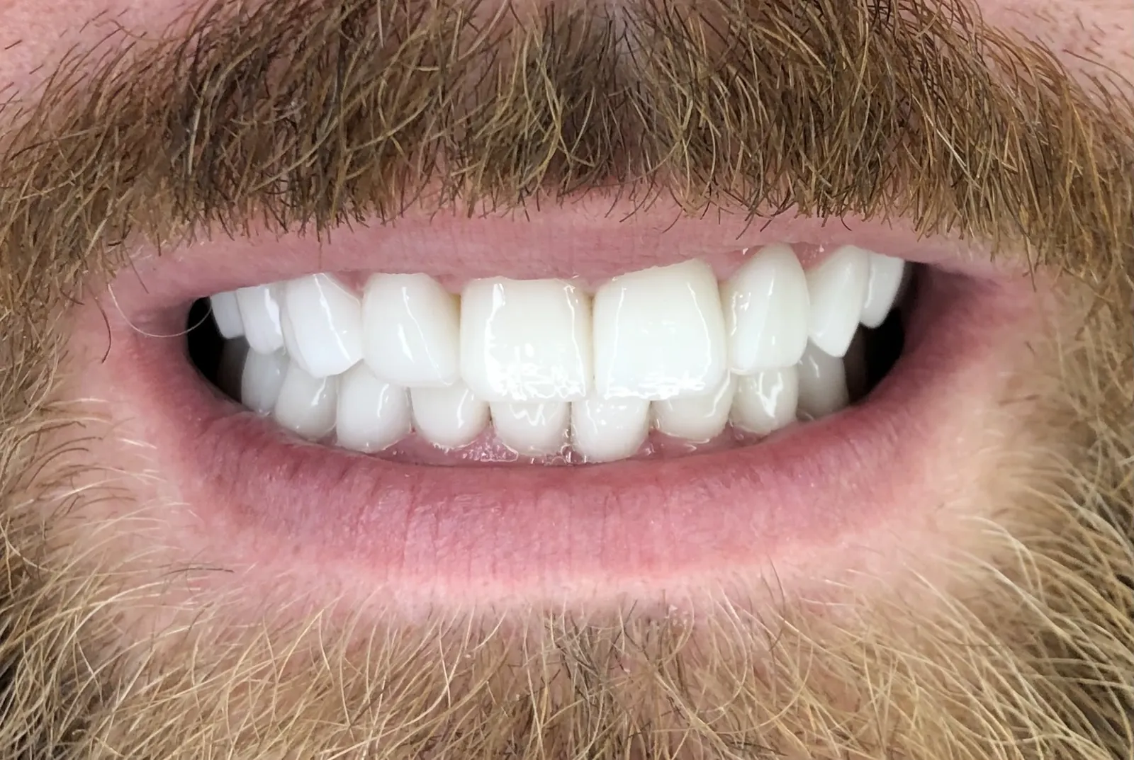 A patient's smile after treatment at Dental C