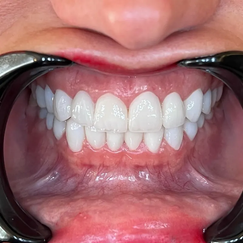 A bright, even smile after cosmetic treatment