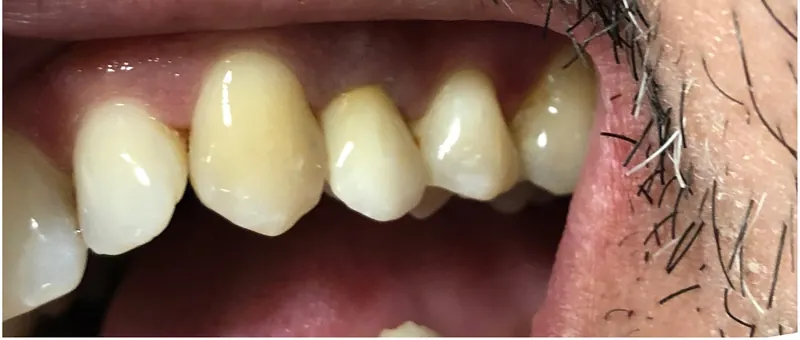 A front tooth rebuilt after treatment