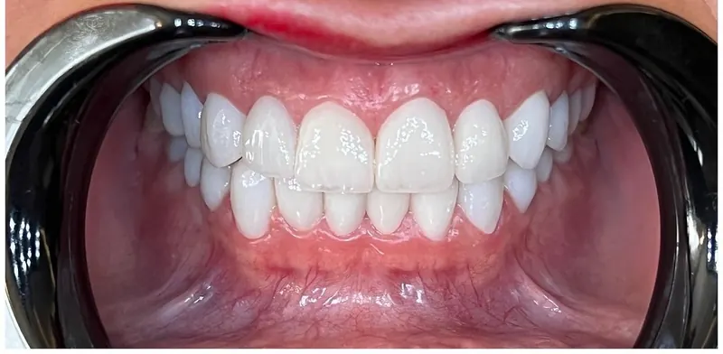 Bright, even teeth after whitening and care